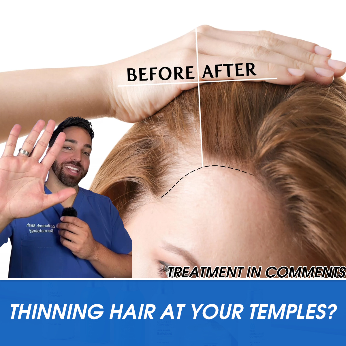 Thinning Hair at Your Temples?