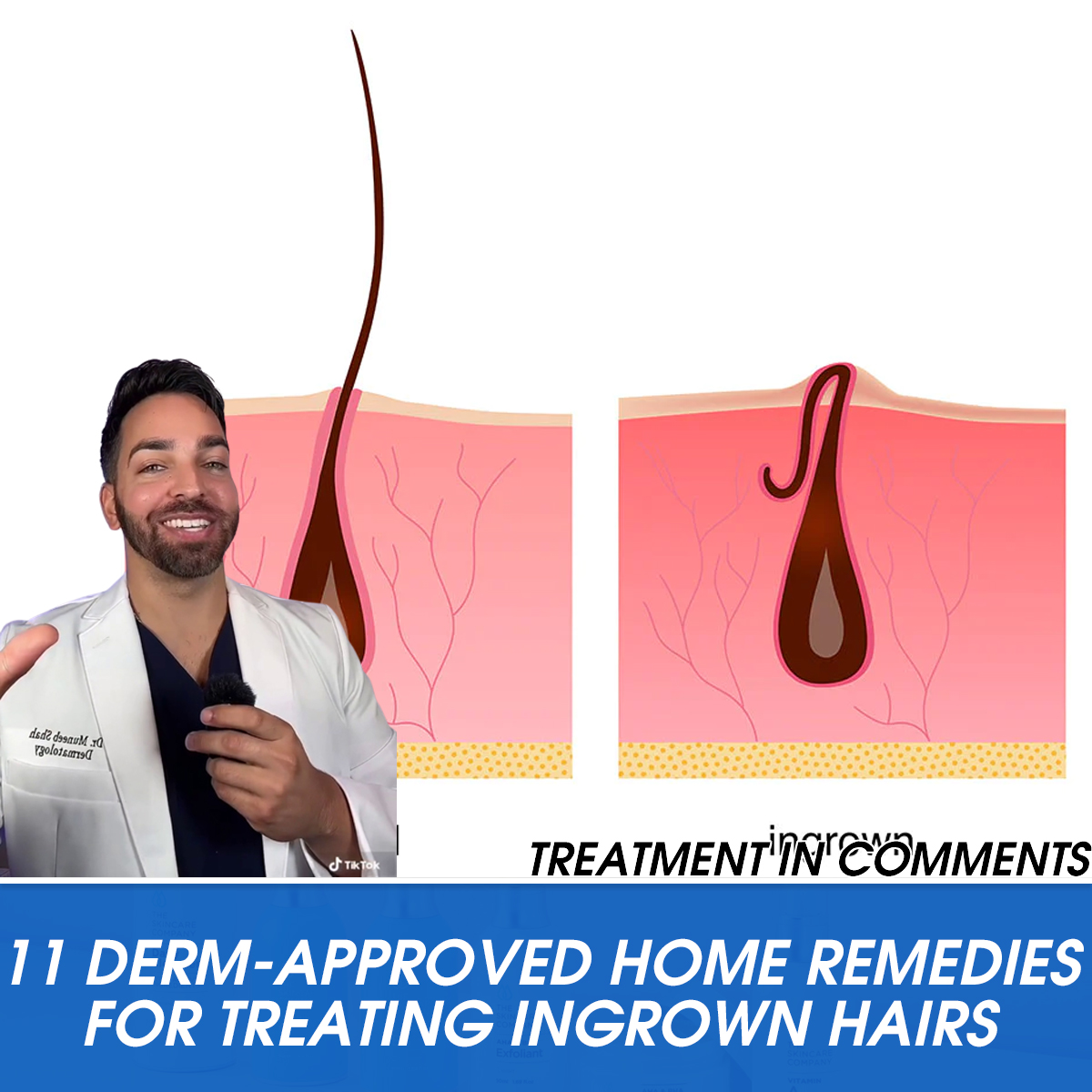 11 Derm-Approved Home Remedies for Treating Ingrown Hairs
