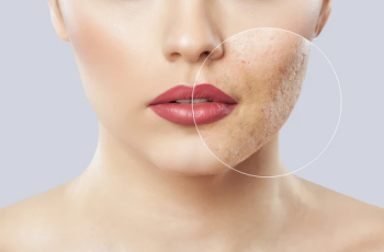How Makeup Affects Acne: Tips for Clear Skin and Breakout Prevention