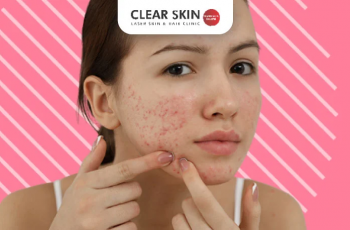 How to Get Rid of Cheek Acne at Home